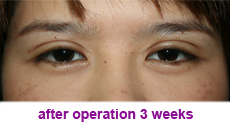 plastic-surgery-blepharoplasty